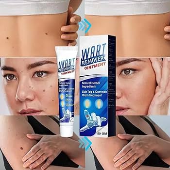 Wart Remover Ointment – Targeted At-Home Care for Common Warts