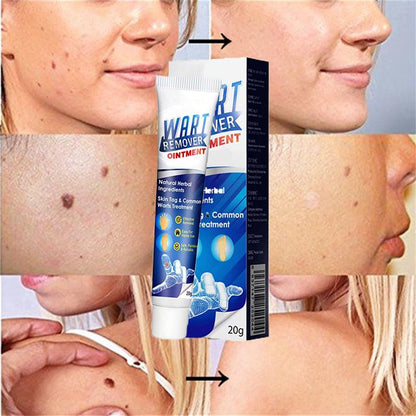 Wart Remover Ointment – Targeted At-Home Care for Common Warts