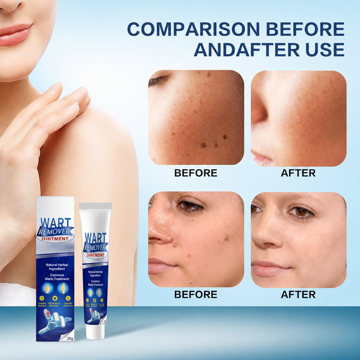 Wart Remover Ointment – Targeted At-Home Care for Common Warts